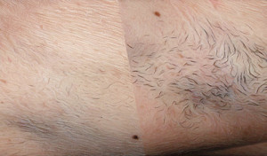 mens laser hair removal Melbourne